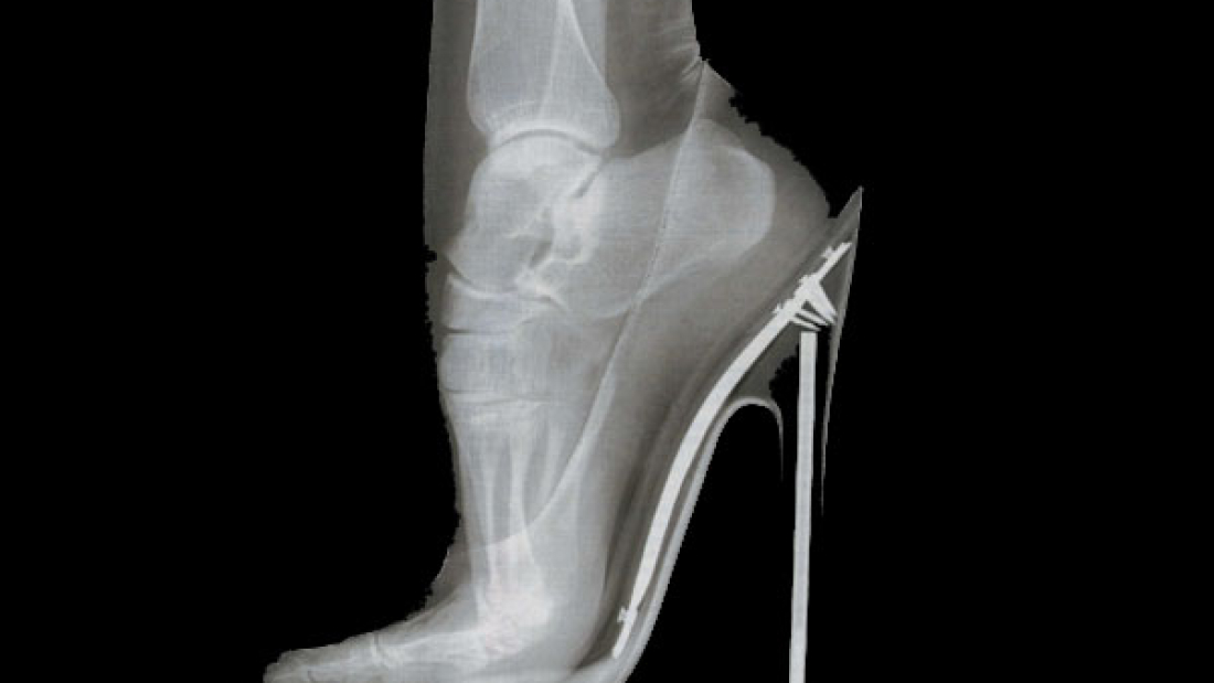 Radiografia-Tacones
